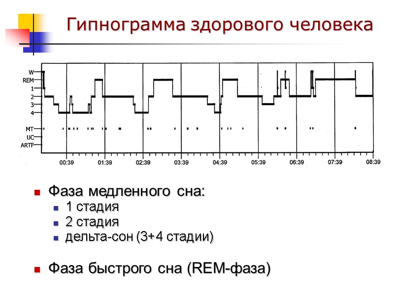 Гипнограмма здорового человека Фаза медленного сна:  1 стадия 2 стадия дельта-сон (3+4 стадии)